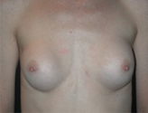 Patient # 57839 Before Photo # 1